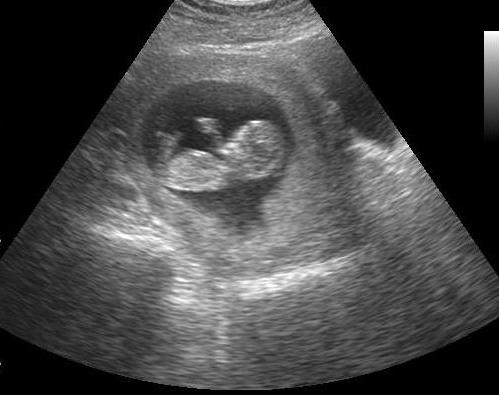waar een abortus moet plaatsvinden in 12 weken 
